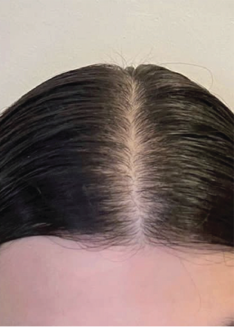 Close-up of a person's scalp with dark hair parted in the middle.